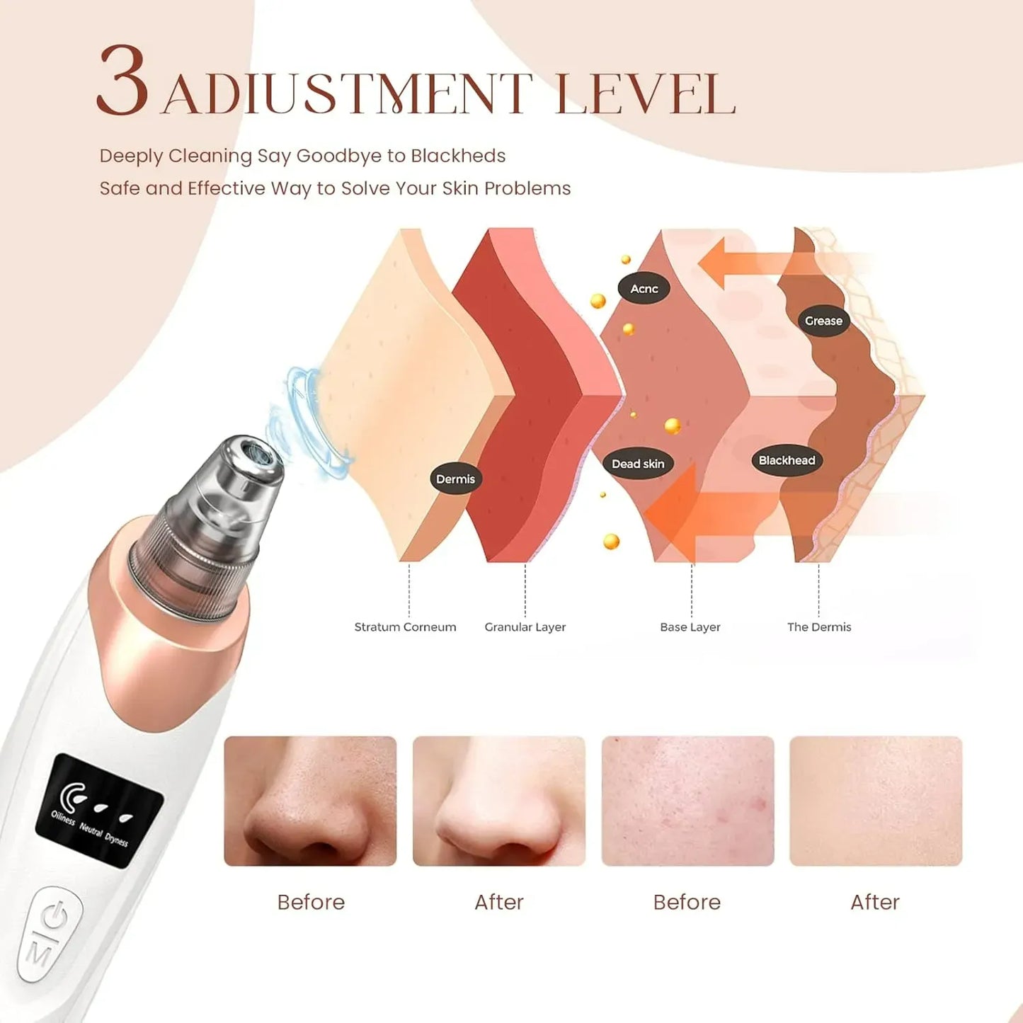 Portable Blackhead Remover