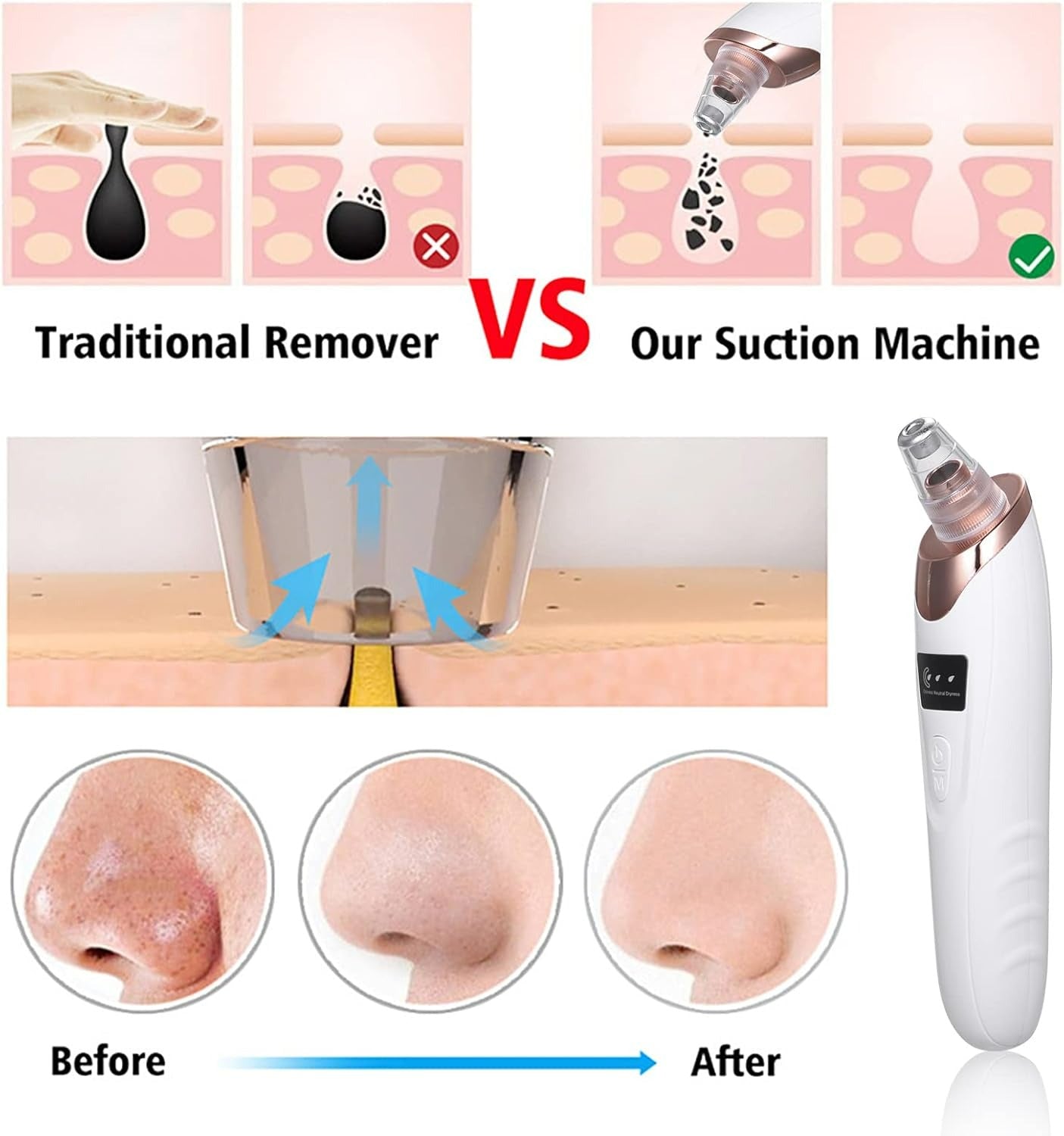 Portable Blackhead Remover